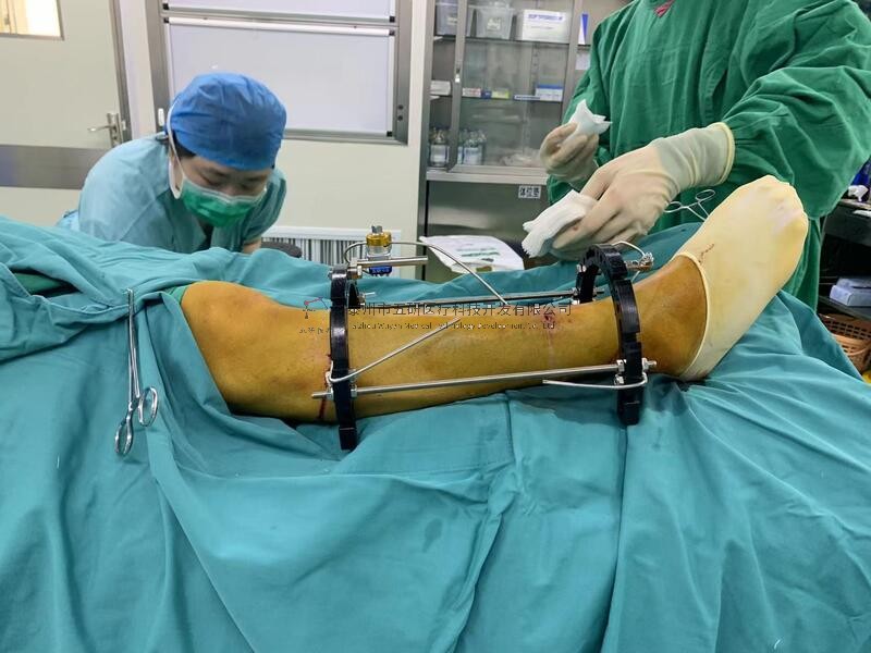 【望京醫院】不開刀治骨折——右脛腓骨骨折病例分享